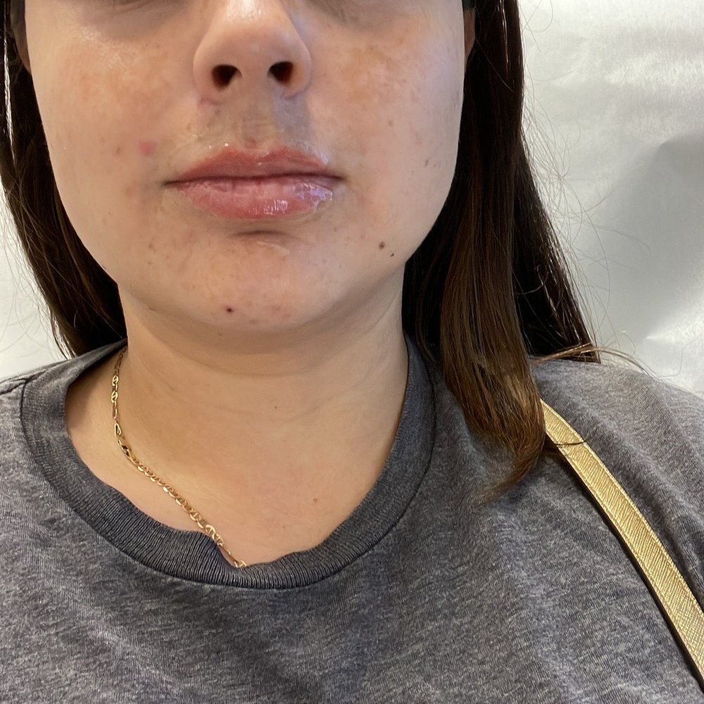 Lazer Lounge - Before with numbing cream - Laser Hair Removal Near Me - Studio City, California Lazer Lounge - Before with numbing cream - Laser Hair Removal Near Me - Studio City, California