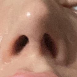 Timothy M Greco, MD - Uneven nostrils caused scar on nose but this Dr thought he did great refuses to admit he did anything wrong