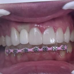 Guess which is the tooth the dentist wanted me to leave with so he could just get rid of me. Horrible quality and service.