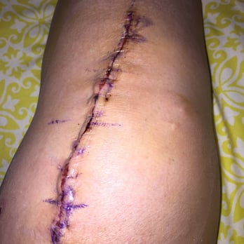 Bugbee William, MD - Left knee allograft- best decision of my life. - Orthopedists Near Me - La Jolla, California Bugbee William, MD - Left knee allograft- best decision of my life. - Orthopedists Near Me - La Jolla, California