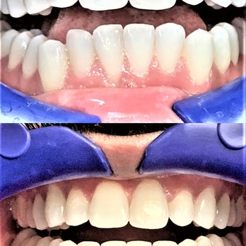 Golden State Dental - Top is before,
bottom is after.
Unfortunately, the after pic doesn't accurately show the positive effects of the teeth whitening - General Dentistry Near Me - Orange, California Golden State Dental - Top is before,
bottom is after.
Unfortunately, the after pic doesn't accurately show the positive effects of the teeth whitening - General Dentistry Near Me - Orange, California