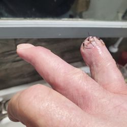 Emergency amputation to keep infection out of blood. Bone infection and no healing through out his care.