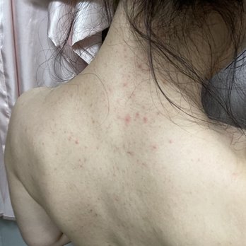 Nena's Waxing - Severe irritation after back waxing (3 days after) - Waxing Near Me - Placentia, California