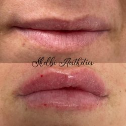 Shelbi Aesthetics and Wellness - This was a full syringe of juviderm - my second time going in 6 months ... she added fullness and additional symmetry