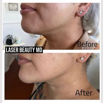 Laser beauty Med Spa - Skin tightening with microneedling radio frequency - Tattoo Removal Near Me - Downey, California Laser beauty Med Spa - Skin tightening with microneedling radio frequency - Tattoo Removal Near Me - Downey, California