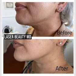 Laser beauty Med Spa - Skin tightening with microneedling radio frequency