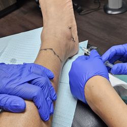 Nooshin Zolfaghari, DPM - VIP Foot & Ankle Center - Receiving second round of amniotic stem cells.
