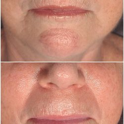 Kalora Skin - Sculptural Facial, smoothing lip lines, San Diego