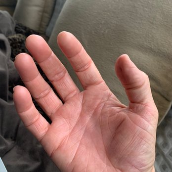 Flourish MD Acupuncture - After: 100% normal! - Acupuncture Near Me - Encinitas, California