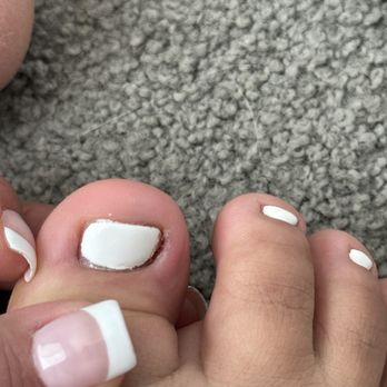 Harmony Nails and Spa - Infected toe and you can see cuticles are cut on my hand as well. - Nail Salons Near Me - Adelanto, California Harmony Nails and Spa - Infected toe and you can see cuticles are cut on my hand as well. - Nail Salons Near Me - Adelanto, California