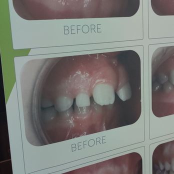 Diamond Bar Dental Studio - Dr Cho can help you with whatever problem you have. Getting my last implant in - Cosmetic Dentists Near Me - Diamond Bar, California