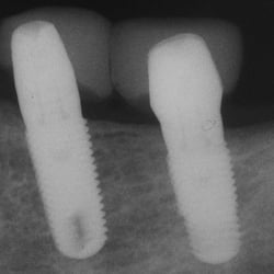 Yelena Vaysman, DDS - X-Ray of lower jaw implants with temporary crowns. Implants placed by Dr. Yuly Gertsberg