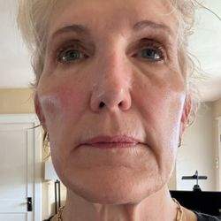 Ridenour Plastic Surgery - Before