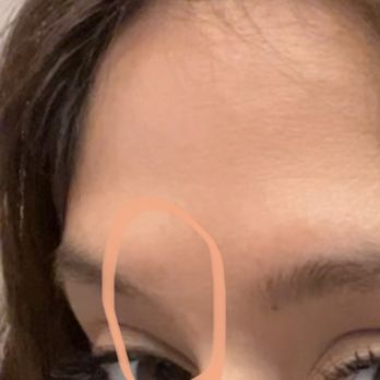 Brows Concept - before picture : scar area hair stopped growing - Eyebrow Services Near Me - Elk Grove, California Brows Concept - before picture : scar area hair stopped growing - Eyebrow Services Near Me - Elk Grove, California