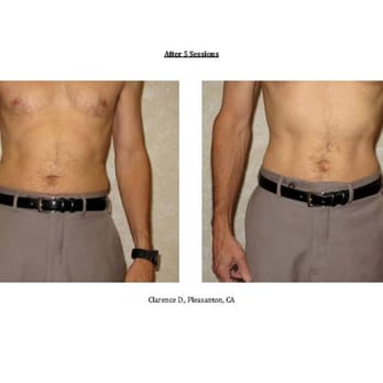 Springtown Chiropractic & Wellness Center - After 5 sessions of Laser-Like Lipo - Chiropractors Near Me - Livermore, California Springtown Chiropractic & Wellness Center - After 5 sessions of Laser-Like Lipo - Chiropractors Near Me - Livermore, California