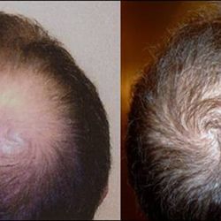 Metropolitan Vein and Aesthetic Center - Neograft before and after