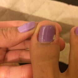 Qeen Nails - Infected toe.