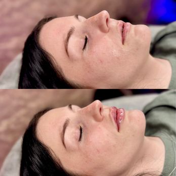 The Best Injector - Before and After Lips - Medical Spas Near Me - Delray Beach, Florida The Best Injector - Before and After Lips - Medical Spas Near Me - Delray Beach, Florida