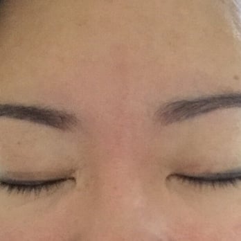 Faces Plus - Day 6. All the scabs (not many, but there were in little chunks) fell off last night. All natural looking. - Skin Care Near Me - San Francisco, California Faces Plus - Day 6. All the scabs (not many, but there were in little chunks) fell off last night. All natural looking. - Skin Care Near Me - San Francisco, California