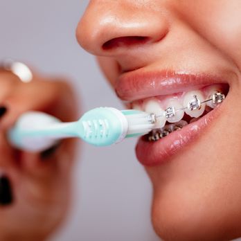 Sonoran Smile Orthodontics - Brushing your teeth is important, but especially if you have braces! - Orthodontists Near Me - Gilbert, Arizona Sonoran Smile Orthodontics - Brushing your teeth is important, but especially if you have braces! - Orthodontists Near Me - Gilbert, Arizona