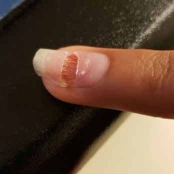 Amy's Nails - My nail healing 6 days later. My nail bed is disfigured I'm unsure why possibly due to the exposed skin. - Nail Salons Near Me - Anchorage, Alaska