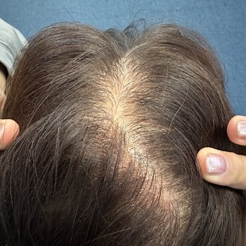 A SCALP - Before - Hair Loss Centers Near Me