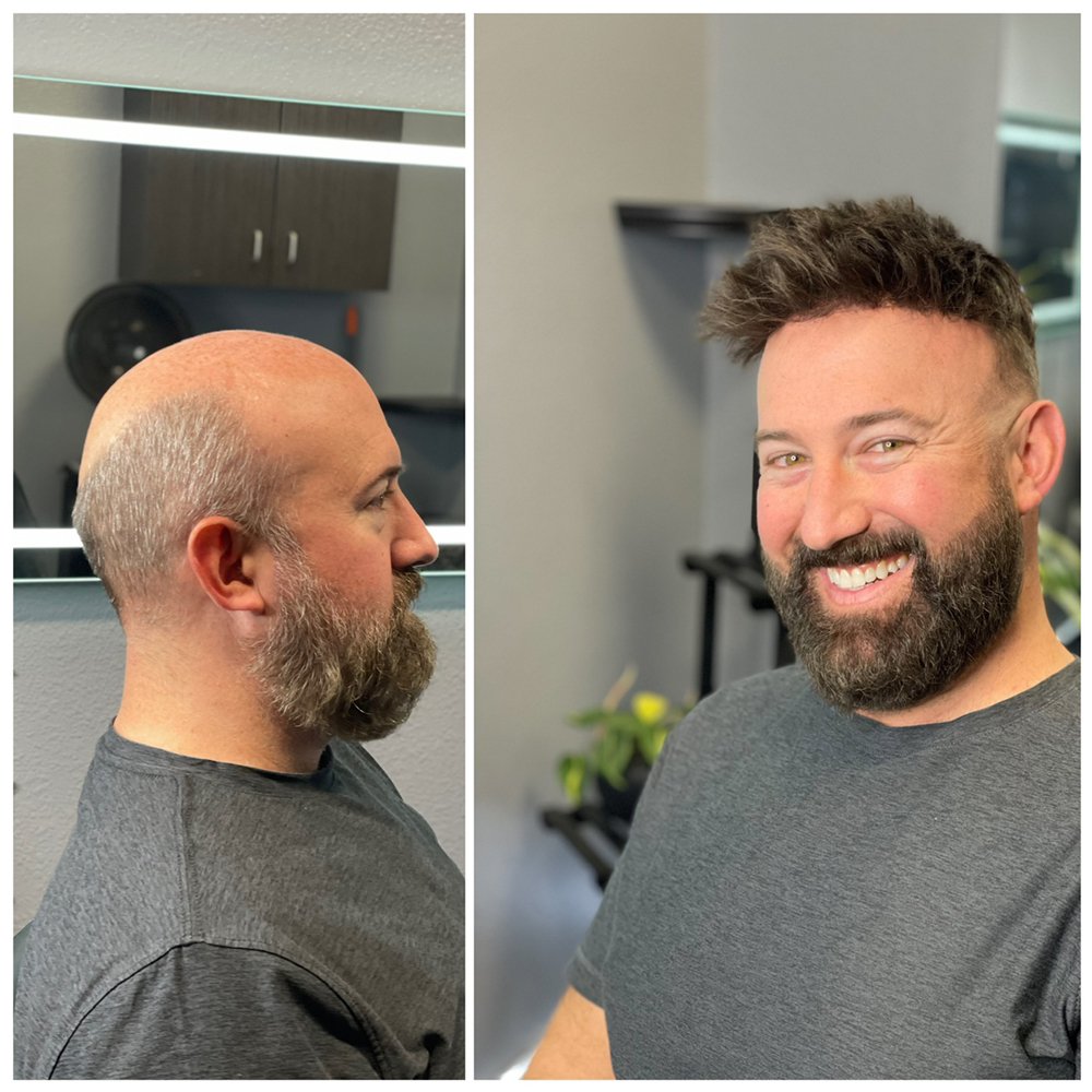 Hair Transplant Westminster California