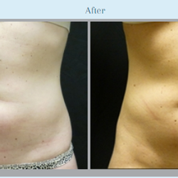 Pickart Plastic Surgery - Liposuction: Before & After