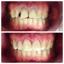 Grace Dental Sugar Land - Bonding Veneer to reshape the teeth and closing the gap. Minimal dentist intervention and same day dentistry