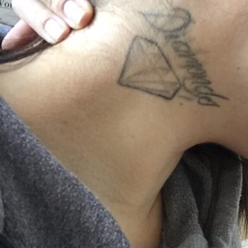INK B GONE Tattoo Removal Denver - Tattoo Removal Near Me - Denver, Colorado INK B GONE Tattoo Removal Denver - Tattoo Removal Near Me - Denver, Colorado