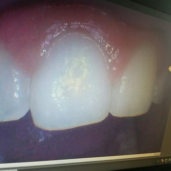 Sachin P Desai, DDS - So beautiful!!!! - Cosmetic Dentists Near Me - Glendora, California Sachin P Desai, DDS - So beautiful!!!! - Cosmetic Dentists Near Me - Glendora, California