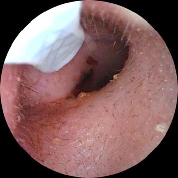 MD Urgent Care - After my Jan 19, 2025, earwax removal, the assistant applied too much pressure, causing tinnitus. It's been days, and I'm losing my mind. - Urgent Care Near Me - Sacramento, California