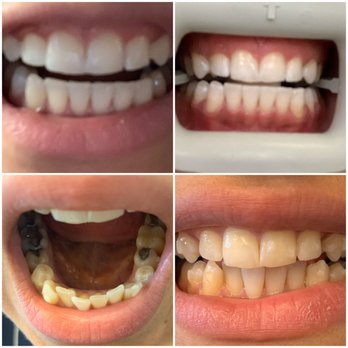 Spring Dental - Invisalign and whitening - General Dentistry Near Me - Walnut Creek, California Spring Dental - Invisalign and whitening - General Dentistry Near Me - Walnut Creek, California