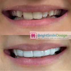 Bright Smile Design - A Dental Veneer compelling before-and-after dental transformation. It effectively showcases the impact of cosmetic dentistry, highlighting