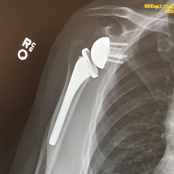 Kyle F Chun, MD - Reverse Total Shoulder Replacement performed by Dr Kyle Chun, Orthopedic Associates. - Orthopedists Near Me