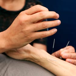Berkeley Community Acupuncture - Acupuncture