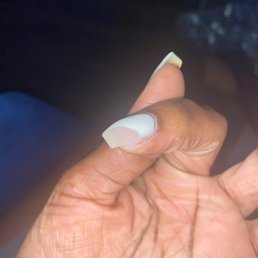Huge chunk of skin punctures by nail filing Huge chunk of skin punctures by nail filing