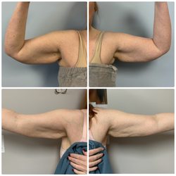 Aesthetics Med Spa - Bodytite arms.