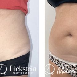 Lickstein Plastic Surgery Medical Spa - Before & After