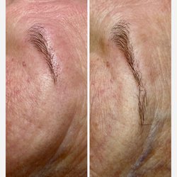 TGS Lab - Eyebrow restoration