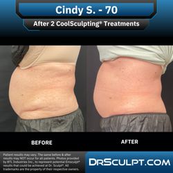 Dr. Sculpt CoolSculpting & EmSculpt Center - After 2 CoolSculpting treatments on abdomen/flanks