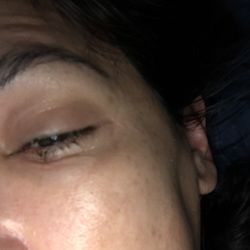 Eye is swollen