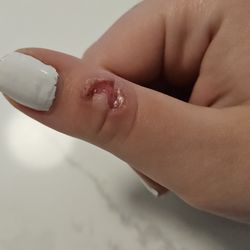 Wallach Derma Center - My daughter's thumb 7 days AFTER Dr. Wallach froze off her wart. It was twice this size originally. She told me every day how much it hurt.