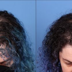 Guy Cappuccino, MD - PRP hair restoration results