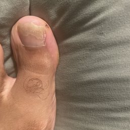 Toe Fungus