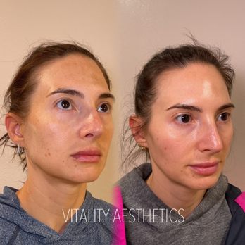 Vitality Aesthetics - Results from our peels and microneedling - Medical Spas Near Me - San Diego, California Vitality Aesthetics - Results from our peels and microneedling - Medical Spas Near Me - San Diego, California