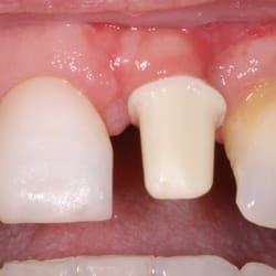 Robert B. Stewart, DDS, MS, PC; Stewart CADLAB - TZ abutment seated on implant #9