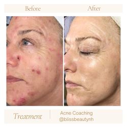 Bliss Beauty Bar - We are Face Reality certified acne experts, your personal acne coaches here to encourage, advise, and guide you to clear skin.