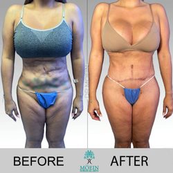 Liposuction Center Moein Surgical Arts - Liposuction 360, Revised Tummy tuck and BBL