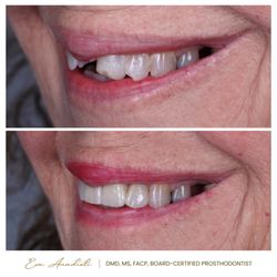 WELNOX Studio - Broken Teeth - Smile Makeover